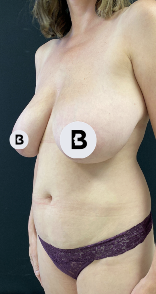 Breast Reduction Before and After Pictures in Buffalo, NY