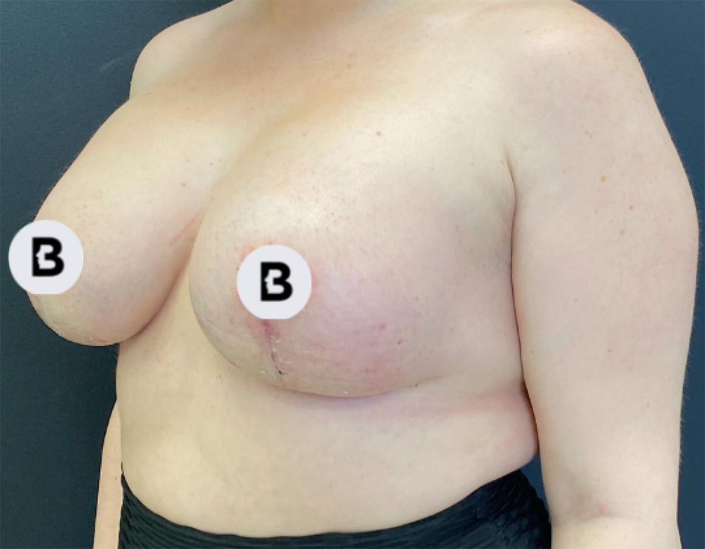 Breast Augmentation Before and After Pictures Buffalo, NY
