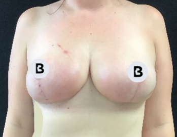 Breast Reduction Before and After Pictures Buffalo, NY