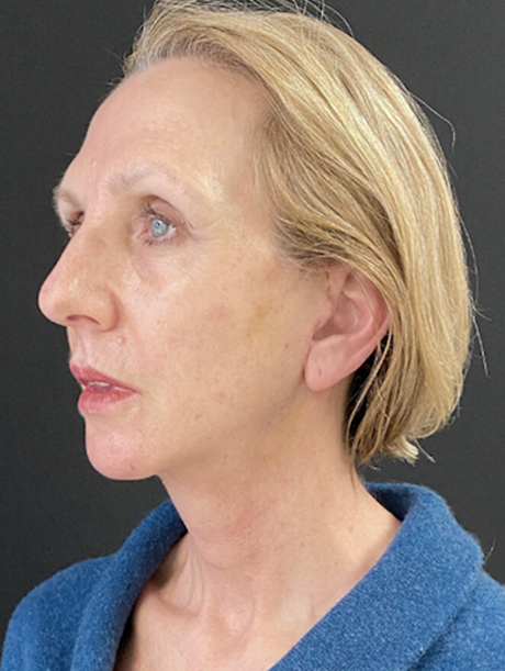 Facelift Before and After Pictures in Buffalo, NY