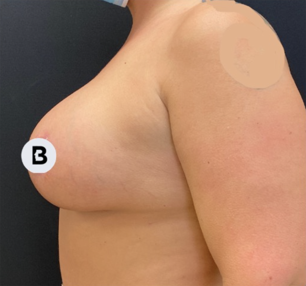 Mastopexy (Breast Lift) Before and After Pictures in Buffalo, NY