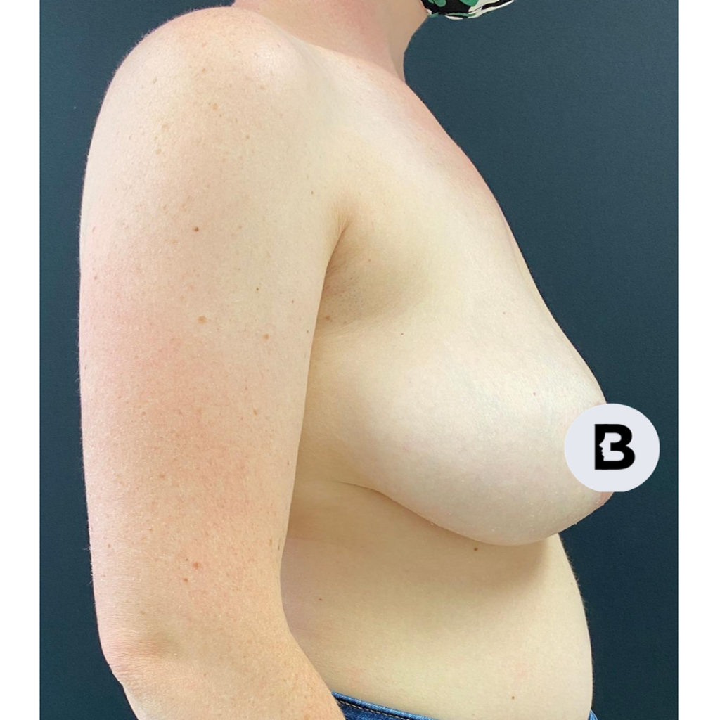 Mastopexy (Breast Lift) Before and After Pictures Buffalo, NY
