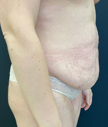 Abdominoplasty (Tummy Tuck) Before and After Pictures Buffalo, NY