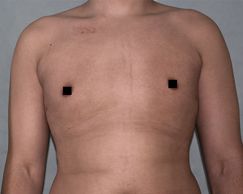 Gynecomastia Before and After Pictures Buffalo, NY