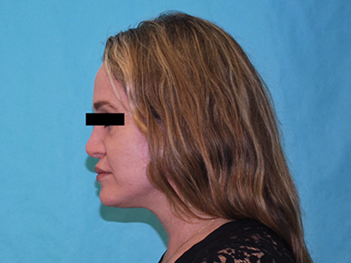 Facelift Before and After Pictures Buffalo, NY