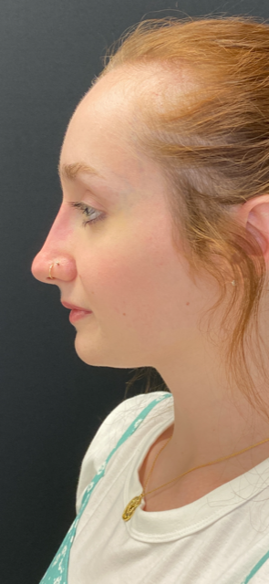 Liquid Rhinoplasty Before and After Pictures Buffalo, NY