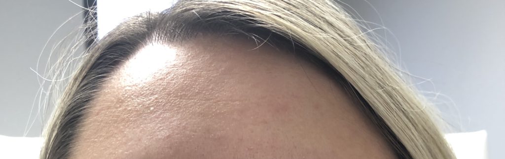 Botox & Dysport Before and After Pictures Buffalo, NY