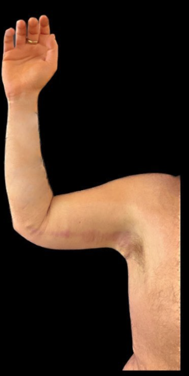 Brachioplasty (Arm Lift) Before and After Pictures Buffalo, NY