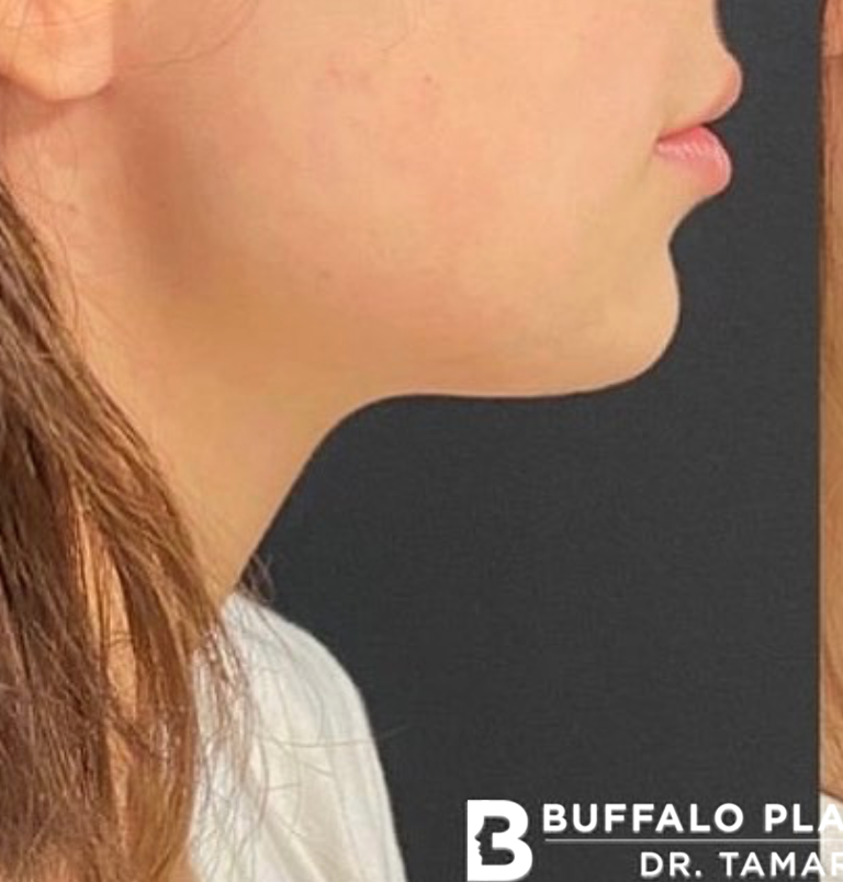 Chin Fillers Before and After Pictures Buffalo, NY
