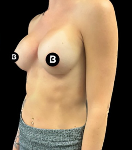 Breast Augmentation Before and After Pictures in Buffalo, NY