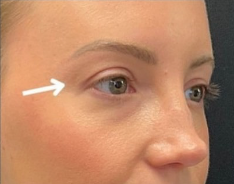 Blepharoplasty (Eyelid Surgery) Before and After Pictures in Buffalo, NY
