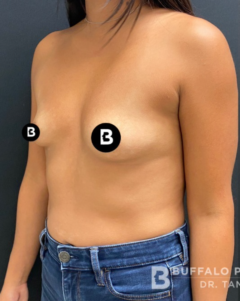 Breast Augmentation Before and After Pictures in Buffalo, NY