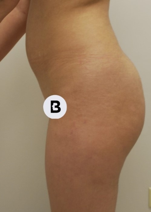 Brazilian Butt Lift Before and After Pictures Buffalo, NY