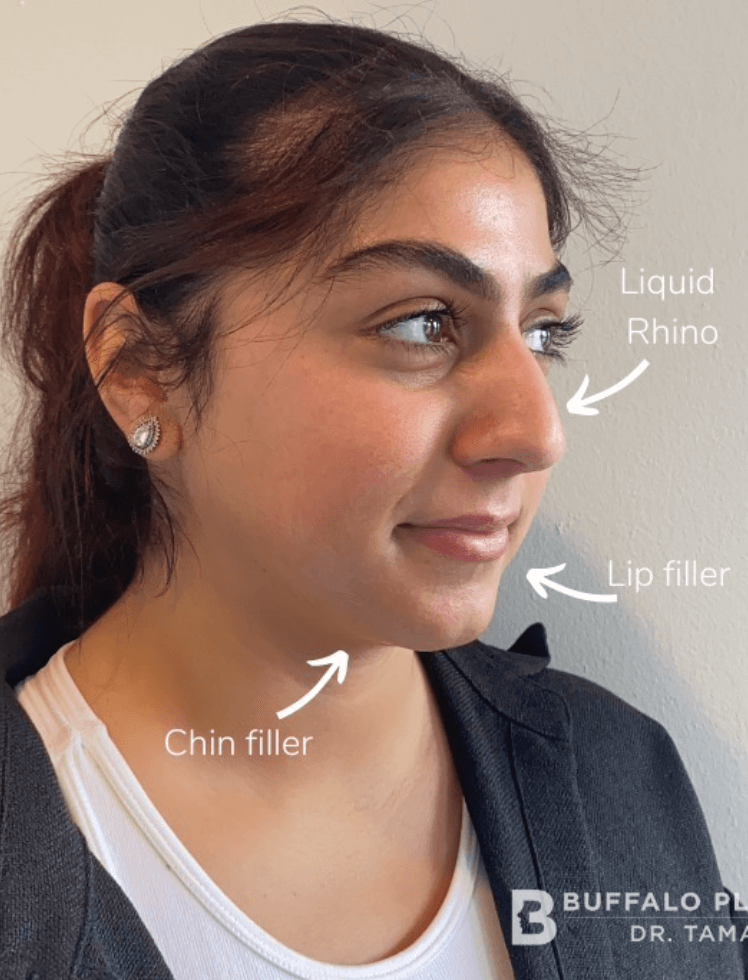 Facial Fillers Before and After Pictures in Buffalo, NY