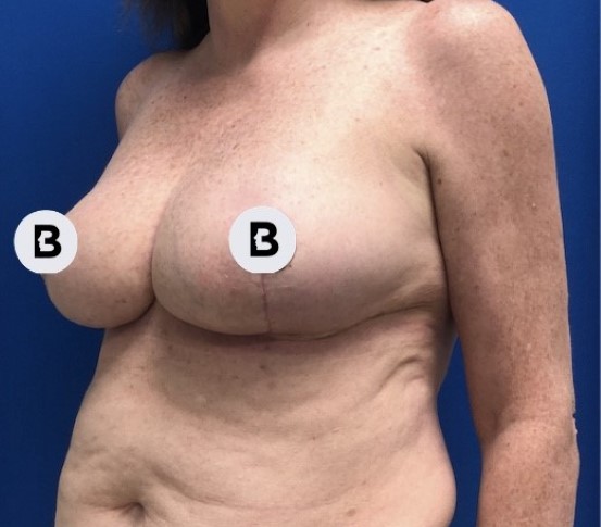 Mastopexy (Breast Lift) Before and After Pictures Buffalo, NY