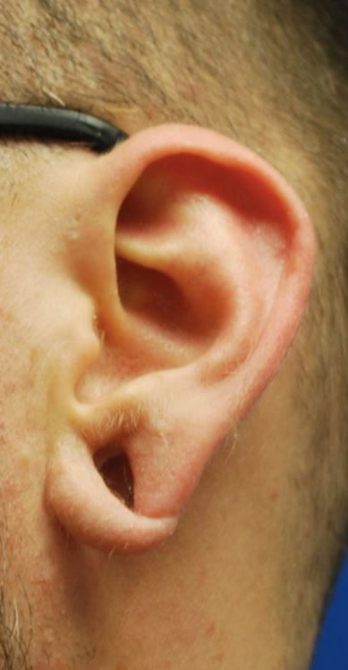 Earlobe Reconstruction Before and After Pictures Buffalo, NY