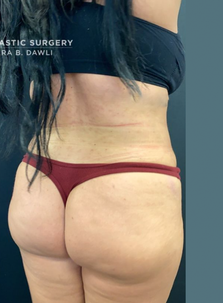 Liposuction Before and After Pictures in Buffalo, NY