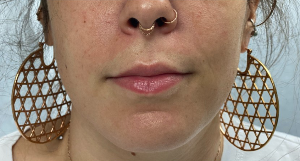 Lip Augmentation Before and After Pictures Buffalo, NY