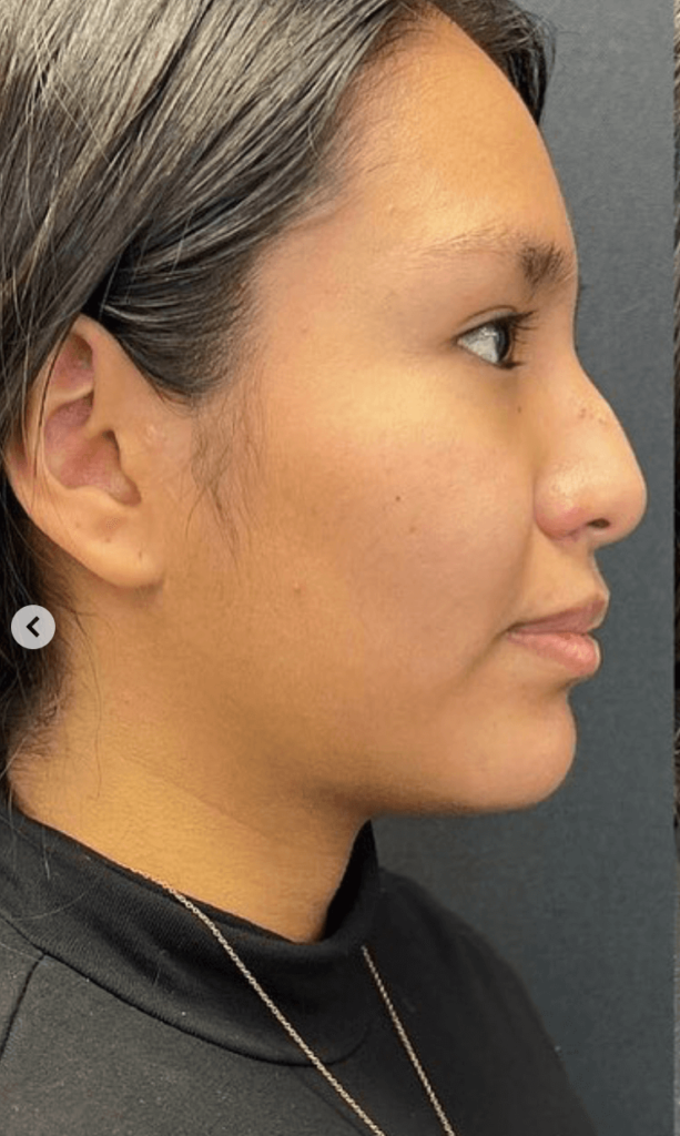 Liquid Rhinoplasty Before and After Pictures in Buffalo, NY