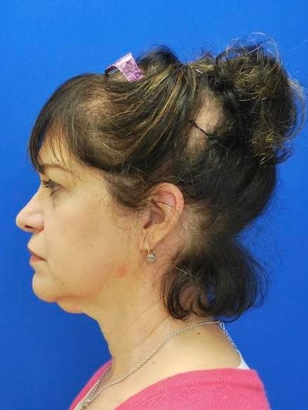 Necklift Before and After Pictures Buffalo, NY