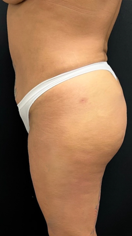 Brazilian Butt Lift Before and After Pictures in Buffalo, NY