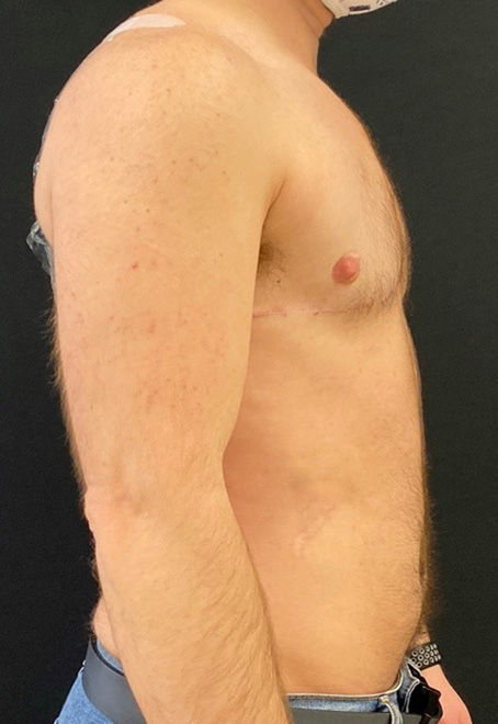 Female to Male Top Surgery Before and After Pictures in Buffalo, NY