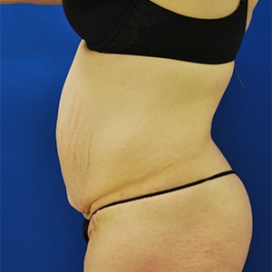 Abdominoplasty (Tummy Tuck) Before and After Pictures Buffalo, NY